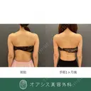 腕の張り出しもすっきり🌴コンプリート脂肪吸引【上腕全周～お背中一部】形成外科専門医がご対応 after画像 サムネイル用