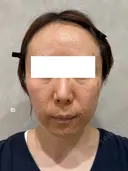 クレーター改善の切り札｜サブシジョンで凹み肌をなめらかに before画像 サムネイル用
