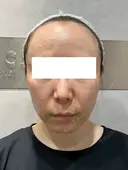 クレーター改善の切り札｜サブシジョンで凹み肌をなめらかに 30日後 サムネイル用