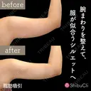 脂肪吸引 30日後 サムネイル用