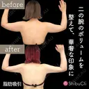 脂肪吸引 30日後 サムネイル用