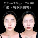 頬・顎下脂肪吸引 90日後 サムネイル用