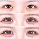 アリエルクイックループトリプル二重埋没法 30日後 サムネイル用