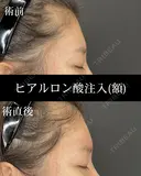 ヒアルロン酸注入（額） 0日後 サムネイル用