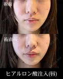 ヒアルロン酸注入 after画像 サムネイル用