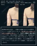 ベイザー脂肪吸引二の腕肩 before画像 サムネイル用