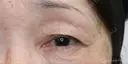【60代女性・目の開きを改善】眼瞼下垂（切開法）＋眉下切開術（3ヶ月後） before画像 サムネイル用