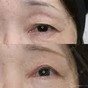 【60代女性・目の開きを改善】眼瞼下垂（切開法）＋眉下切開術（3ヶ月後） 90日後 サムネイル用