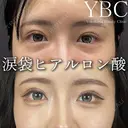 【🐰涙袋ヒアルロン酸🐰】 before画像 サムネイル用