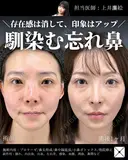 鼻整形（プロテーゼ/鼻尖形成/鼻中隔延長/小鼻ボトックス/他院修正） after画像 サムネイル用