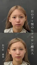 【目の下】ヒアルロン酸注入 after画像 サムネイル用