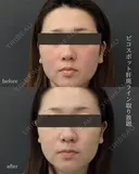ピコレーザー（ピコスポット） before画像 サムネイル用