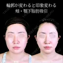 頬・顎下脂肪吸引/糸リフト/エラボトックス 180日後 サムネイル用