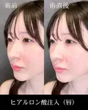 ヒアルロン酸注入（唇） after画像 サムネイル用