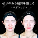 エラボトックス 90日後 サムネイル用