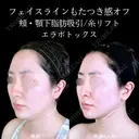 頬・顎下脂肪吸引/糸リフト/エラボトックス before画像 サムネイル用