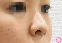 隆鼻術（シリコンプロテーゼ） +鼻翼（切開）ハイパー法 before画像 サムネイル用
