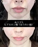 糸リフト/ヒアルロン酸注入（ほうれい線） before画像 サムネイル用