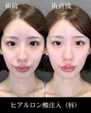 ヒアルロン酸注入（唇） before画像 サムネイル用