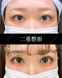 二重埋没 before画像 サムネイル用