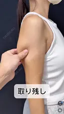 シークレット脂肪吸引二の腕 before画像 サムネイル用