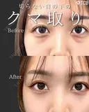 目の下のクマ取り・目の下のたるみ（ふくらみ）取り after画像 サムネイル用