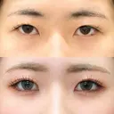 白目拡大術 after画像 サムネイル用