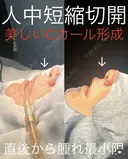 人中短縮　Cカール形成 after画像 サムネイル用