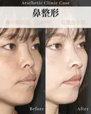 鼻中隔延長　肋軟骨使用 before画像 サムネイル用