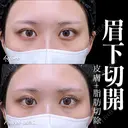 眉下切開/ROOF切除 before画像 サムネイル用