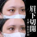 眉下切開/ROOF切除 7日後 サムネイル用