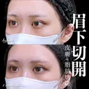 眉下切開/ROOF切除 7日後 サムネイル用