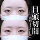 目頭切開 180日後 サムネイル用