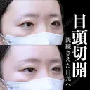 目頭切開 180日後 サムネイル用