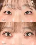 二重埋没法、目の上（まぶた）の脂肪・ふくらみ取り、目頭切開法 before画像 サムネイル用
