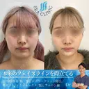 3D脂肪吸引(頬・顎)/ 糸リフト /メーラーファット除去/ あごヒアルロン酸/エラボトックス before画像 サムネイル用