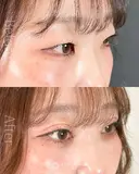 二重埋没法、目の上（まぶた）の脂肪・ふくらみ取り、目頭切開法 30日後 サムネイル用