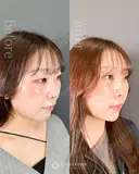 二重埋没法,目の上（まぶた）の脂肪・ふくらみ取り,目頭切開法,美肌スレッド（糸によるリフトアップ）,ジョールファット除去,メーラーファット除去,アゴのヒアルロン酸注入 before画像 サムネイル用