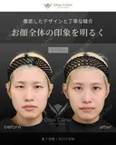 眉下切開 / ROOF切除 before画像 サムネイル用