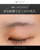 眉下切開 / ROOF切除 180日後 サムネイル用