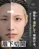 眉下切開 / ROOF切除 before画像 サムネイル用
