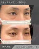 男性からも人気施術！目の下のクマ取り、脂肪注入😌☘️ after画像 サムネイル用