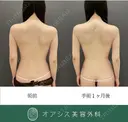 【背中全体】+【腹部フル】コンプリート脂肪吸引🌴お背中とのセット治療でスッキリ感が大きく✨ after画像 サムネイル用