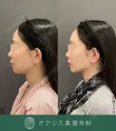 脂肪吸引のみを希望の方に🌴コンプリート脂肪吸引【頬・顎下】形成外科専門医がご対応 before画像 サムネイル用