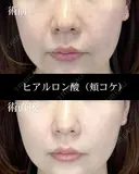 ヒアルロン酸注入（頬） after画像 サムネイル用