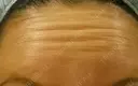 【額】ボトックス注射 before画像 サムネイル用