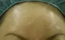【額】ボトックス注射 after画像 サムネイル用