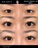 二重埋没（自然癒着法） 30日後 サムネイル用