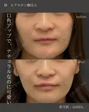 【リップ】ヒアルロン酸注入 after画像 サムネイル用
