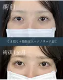 裏下スタンダードプラス脂肪注入+ナノリッチ　 before画像 サムネイル用